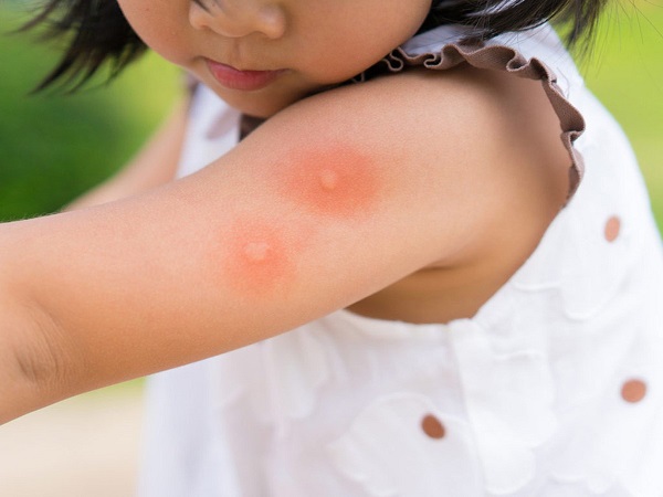 Vì sao trẻ nhỏ dễ bị muỗi đốt, côn trùng cắn?