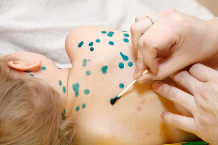 Dùng thuốc xanh bôi lên vết thủy đậu là một trong những cách giúp trị thủy đậu ở trẻ