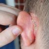 Hăm vành tai thực chất là viêm kẽ tai