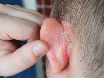 Hăm vành tai thực chất là viêm kẽ tai