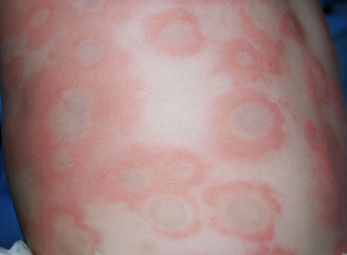 Những nốt sẩn đỏ trên bề mặt da trẻ khi bị mề đay