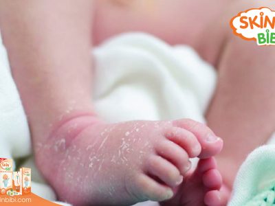 Tìm hiểu về chứng khô da ở trẻ sơ sinh