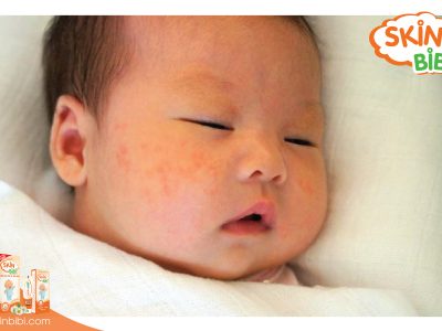 Trẻ sơ sinh bị mẩn ngứa, nguyên nhân và cách xử trí