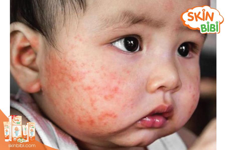 Tuyệt chiêu phòng ngừa tái phát chàm sữa cho bé mùa nắng nóng