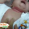 Vì sao bé bị hăm da ở cổ