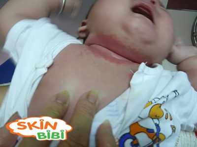 Vì sao bé bị hăm da ở cổ